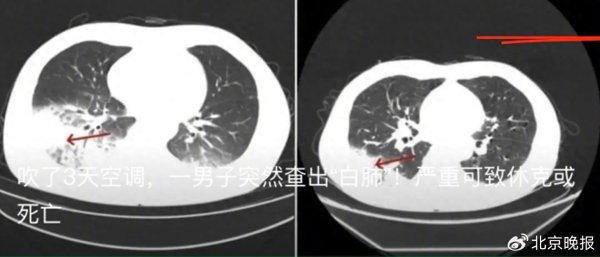 a股配资 空调吹成白肺？这个致病菌到底从何而来